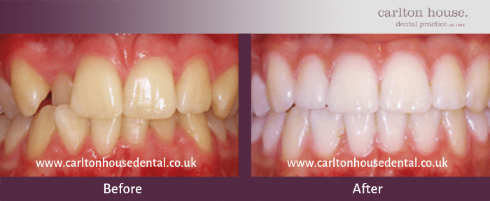 boutique teeth whitening before and after 1
